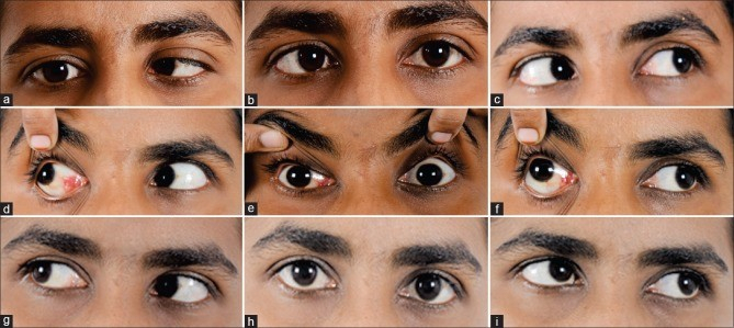 An Update on the Effects and Complications of BoNT-A in the Management of Third, Fourth, and Sixth Nerve Palsies: A Narrative Review.