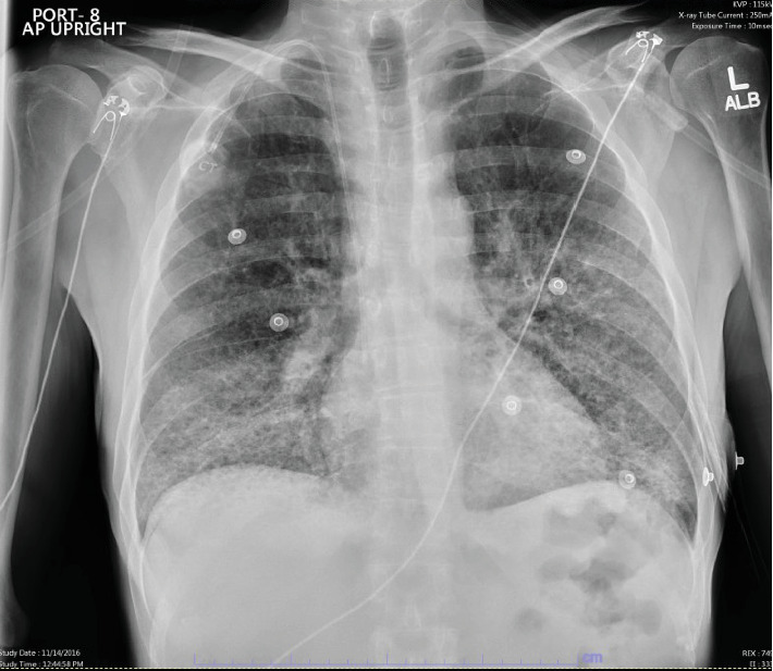 Mit-O-My I Can't Breath! Mitomycin C-Induced Pneumonitis Leading to Acute Respiratory Distress Syndrome, a Rare Case.