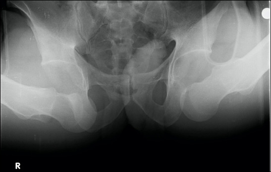 Bilateral anterior obturator hip dislocation without fracture: A rare case report with unusual etiology.