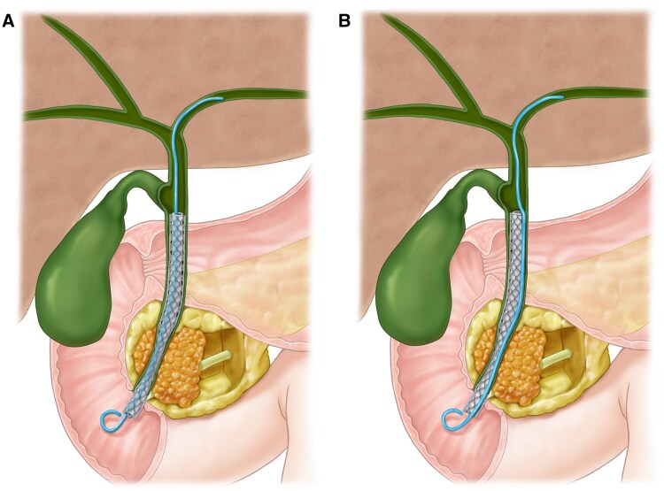 Prevention of stent migration of covered self-expandable metal stents in distal malignant biliary obstruction: a review of literature.