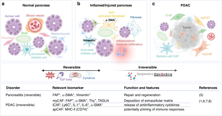 The influence of clinical risk factors on the classification of human cancer-associated fibroblasts in PDAC and pancreatitis patients.