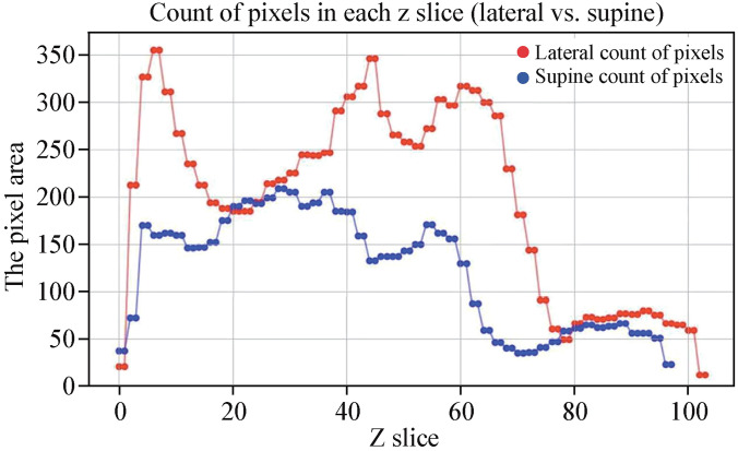 Impact of lateral positioning on upper airway morphology in sedated children under five.