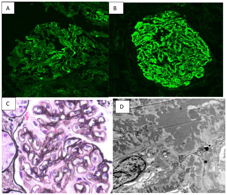 Case Report: Full-house renal-limited lupus-like nephritis in pregnancy.