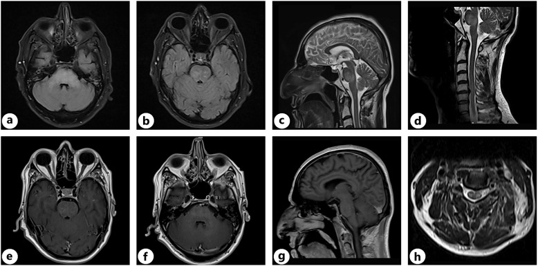 Neurological Immune-Related Adverse Events in Patients Treated with Anti-Programmed Death 1 Agent, Pembrolizumab: A Case Series.