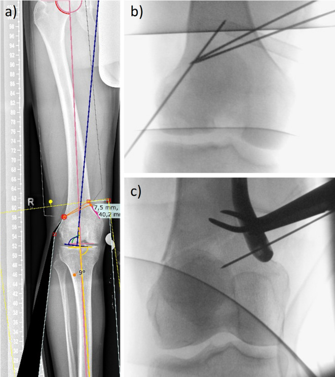 Effects of K-wire diameter and insertion angle on femoral bone medial closing-wedge osteotomies: a finite element study.