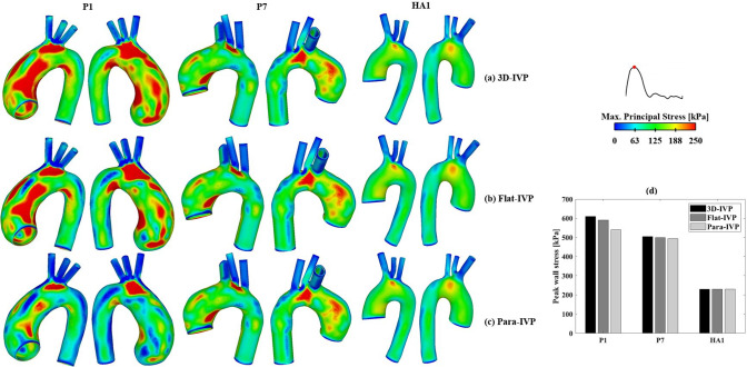 A combined 4D flow MR imaging and fluid–structure interaction analysis of ascending thoracic aortic aneurysms