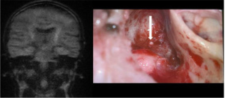 Detection of cholesteatoma recurrence by magnetic resonance imaging (DWI non-EPI sequence) - how can we minimise false results?