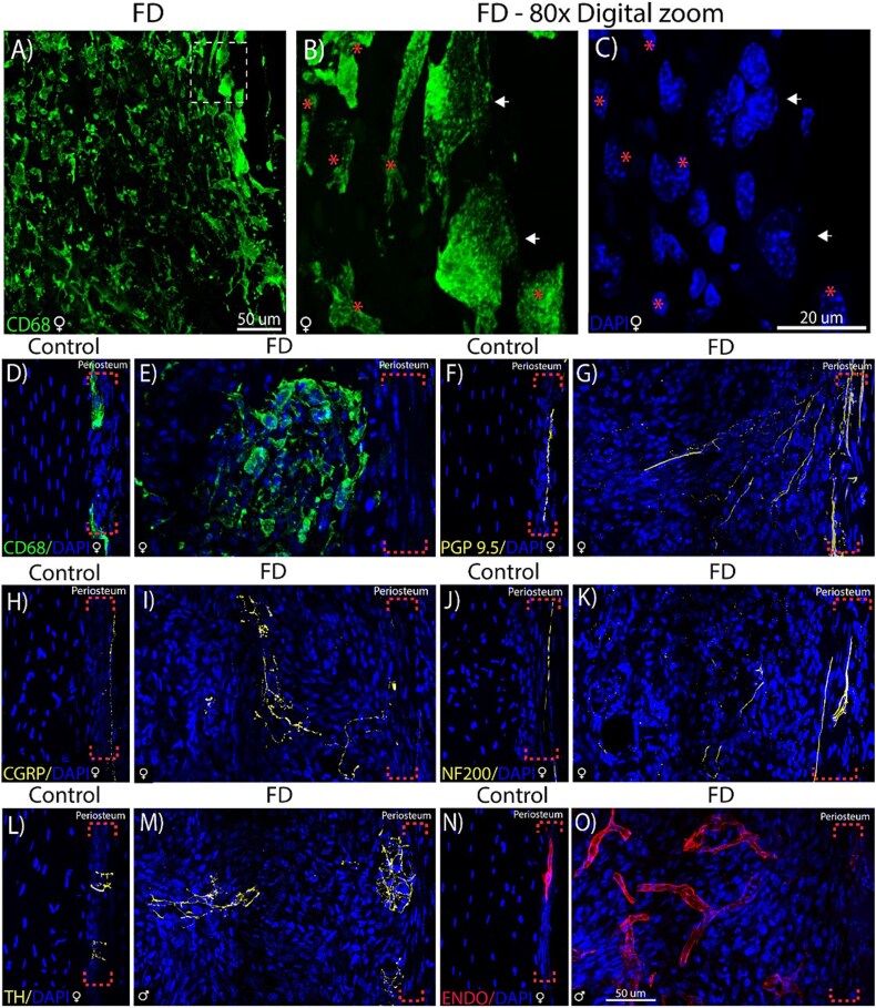 Pain in fibrous dysplasia: identifying nociceptive mechanisms in a preclinical model.