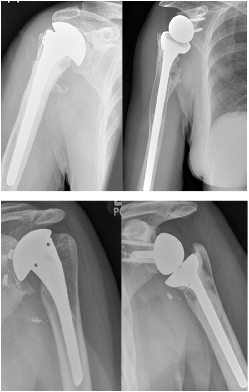 Shoulder replacement in the under 55's is anatomical or reverse the best solution?