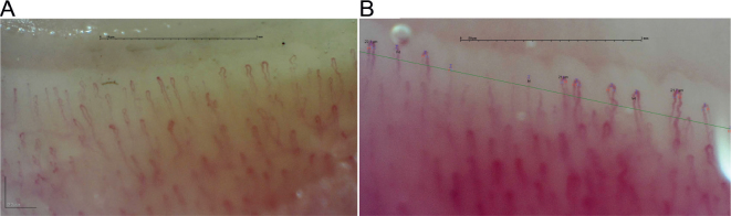 Capillaroscopic Changes in a Patient with Undifferentiated Connective Tissue Disease - A Diagnostic Challenge: A Quiz.