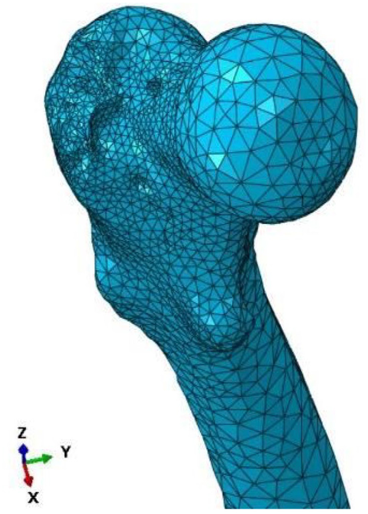 Analysis of Muscle Forces and Their Impact on Femoral Bone Stresses Using Response Surface Methodology (RSM).