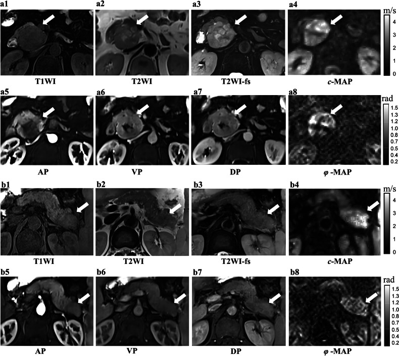 Added value of multifrequency magnetic resonance elastography in predicting pathological grading of pancreatic neuroendocrine neoplasms.