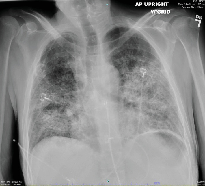 Mit-O-My I Can't Breath! Mitomycin C-Induced Pneumonitis Leading to Acute Respiratory Distress Syndrome, a Rare Case.