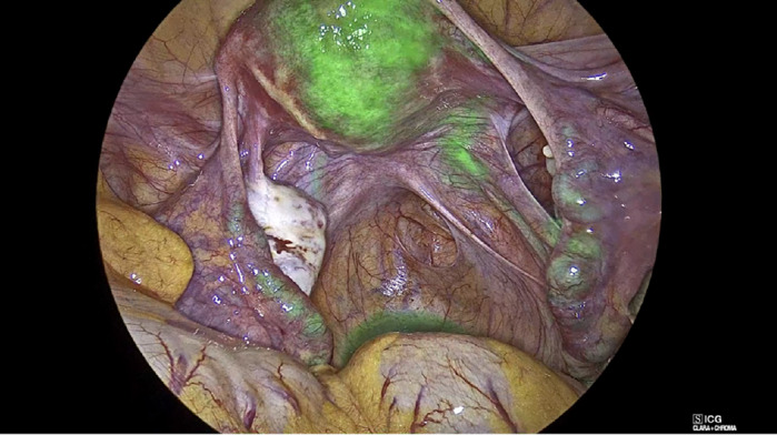Improving efficacy and safety of surgery in benign gynaecology: the case for indocyanine green.