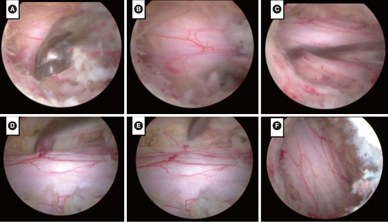 Biportal Endoscopic Decompression for Degenerative Lumbar Spondylolisthesis With Stenosis.