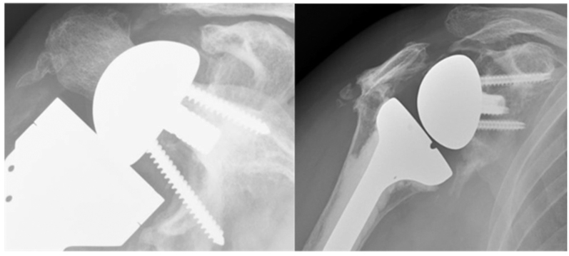 Shoulder replacement in the under 55's is anatomical or reverse the best solution?