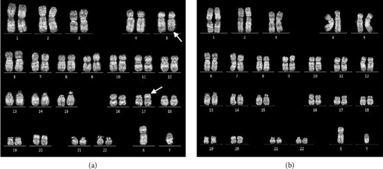 <i>MPRIP::PDGFRB</i> Fusion Gene: A Rare Case Report of Adult Myeloid/Lymphoid Neoplasm With Eosinophilia and Tyrosine Kinase Gene Fusions.