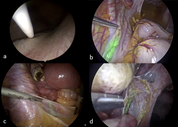 Improving efficacy and safety of surgery in benign gynaecology: the case for indocyanine green.