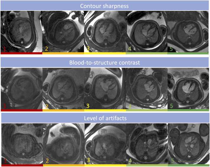 Factors influencing image quality in fetal cardiovascular magnetic resonance cine imaging using Doppler ultrasound gating: A multicenter study.