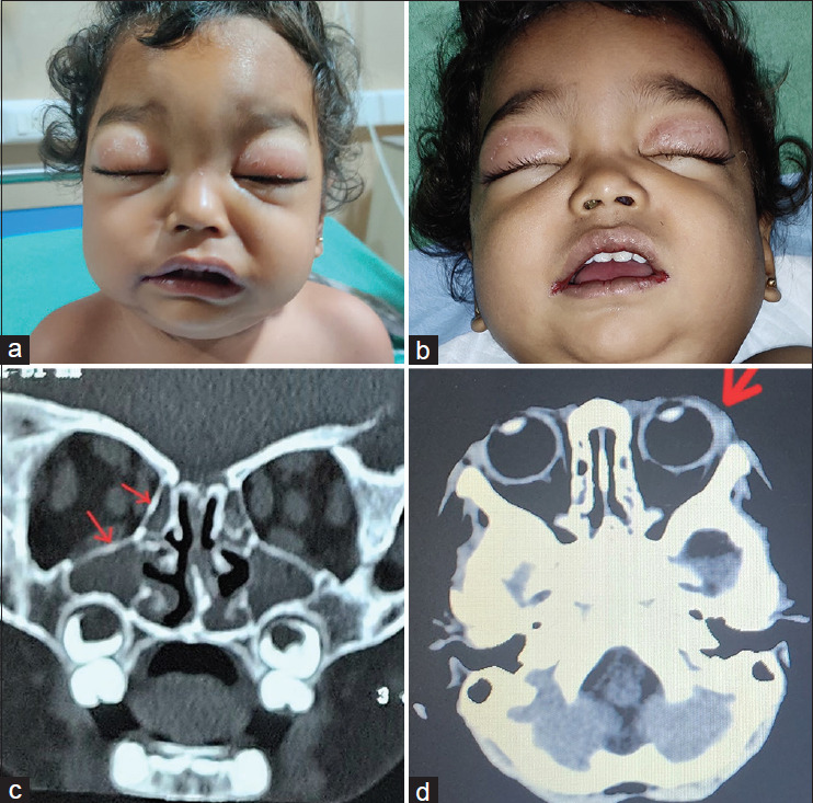 Incomplete Kawasaki Disease Presenting as Orbital Cellulitis in a Child.