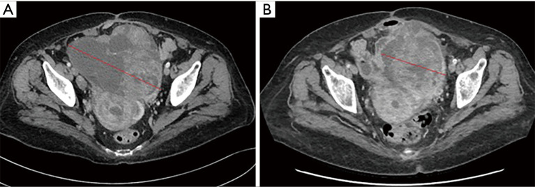 Efficacy and safety of dostarlimab in elderly patients with multiple comorbidities and allergic diathesis: case report.