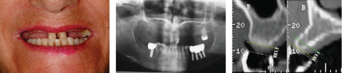 Eighteen-Year Follow-Up of Bone Sculpting Using the 3A-2B Biological Rule for Immediate and Late Implant Placement With Immediate Loading in Maxillary Fixed Prostheses: A Clinical Report.