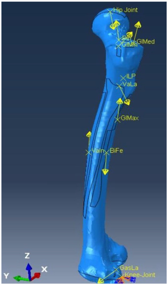 Analysis of Muscle Forces and Their Impact on Femoral Bone Stresses Using Response Surface Methodology (RSM).