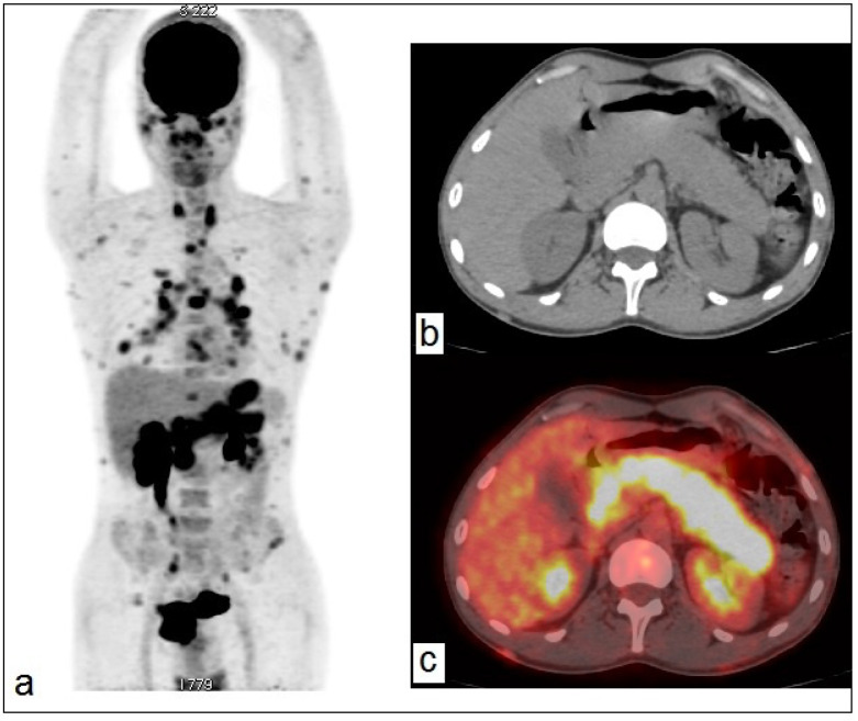 Pancreatic Involvement in Follicular Lymphoma Detected on <sup>18</sup>FDG-PET/CT.