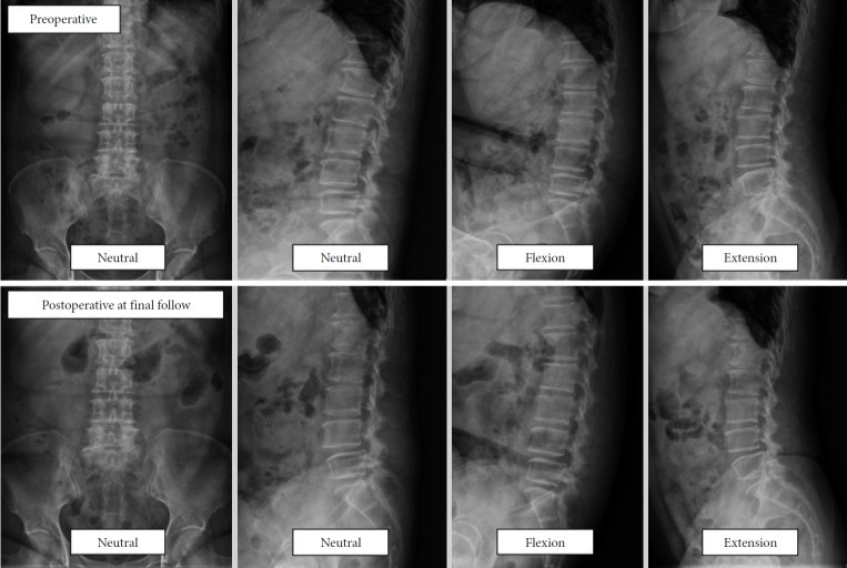 Biportal Endoscopic Decompression for Degenerative Lumbar Spondylolisthesis With Stenosis.