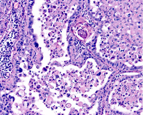 Squamous Cell Carcinoma: A Clinical and Histopathological Review of a South African Tertiary Dermatology Unit.