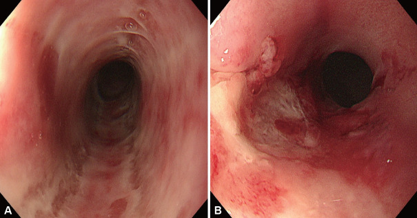 Esophageal Mucosal Injuries From Drugs, Radiation, and Caustic Agents.