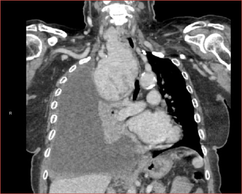 Surgical approaches to the management of the intrathoracic goiter - A systematic review.