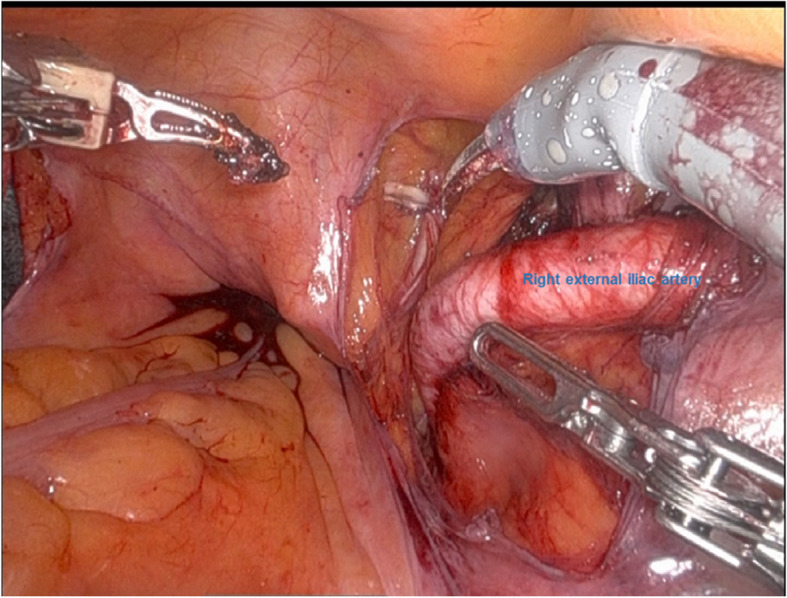 Usefulness of lower extremity pulse oximetry for detection of external iliac artery dissection during robot-assisted radical prostatectomy.