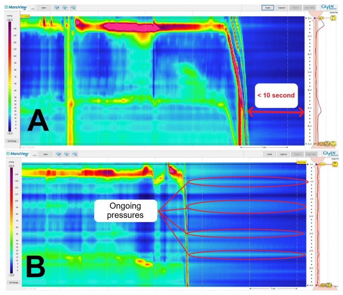 Thermal compensation algorithm in ManoScan™ high resolution esophageal manometry: does it really affect manometry metrics and final diagnosis?