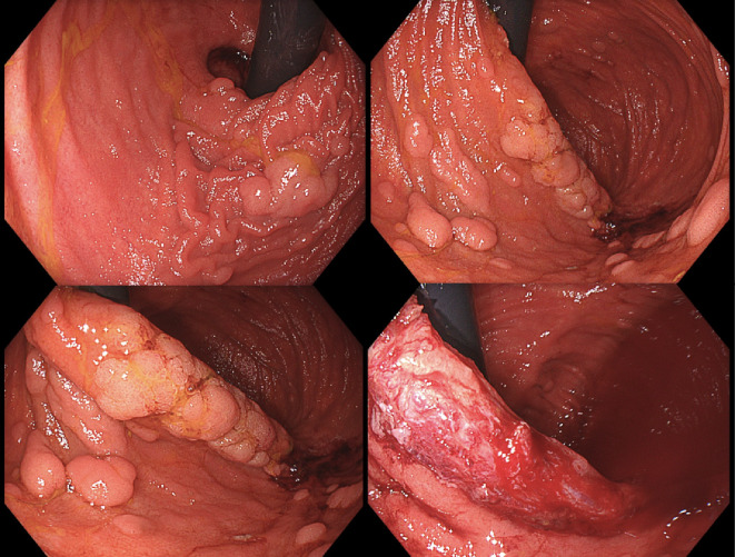 Familial adenomatous polyposis: non-surgical management of large bowel disease: endoscopic and chemoprevention strategies.