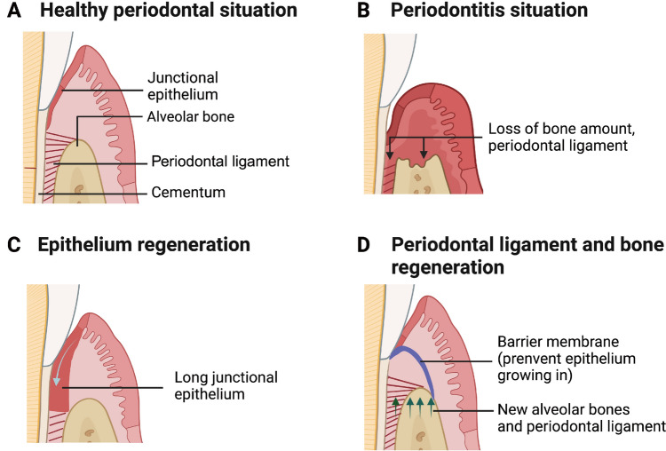 Implantable Dental Barrier Membranes as Regenerative Medicine in Dentistry: A Comprehensive Review.