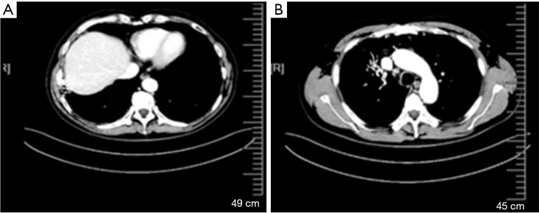 Heterogeneity and co-occurrence of resistance mechanisms in EGFR-TKI-induced NSCLC to SCLC transformation: a case report.