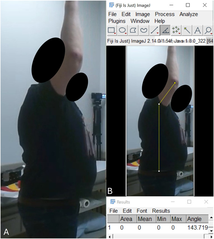 Accuracy and Reliability of Video-Based Range-of-Motion Assessments in Postreconstruction Brachial Plexus Patients.