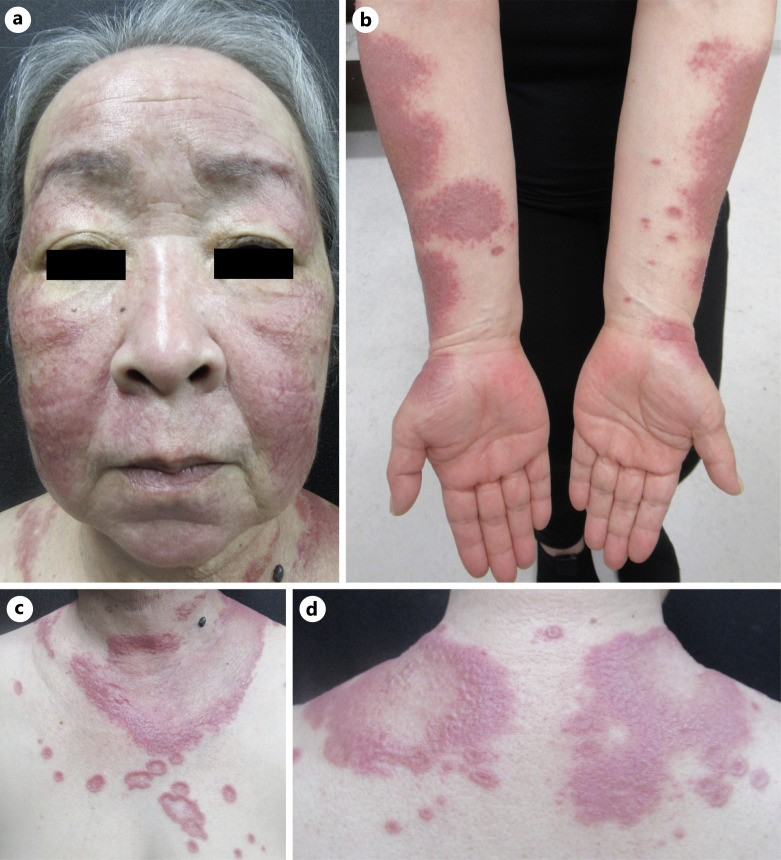 Photo-Induced Sarcoidosis in a Diabetic Patient Receiving Metformin Hydrochloride.