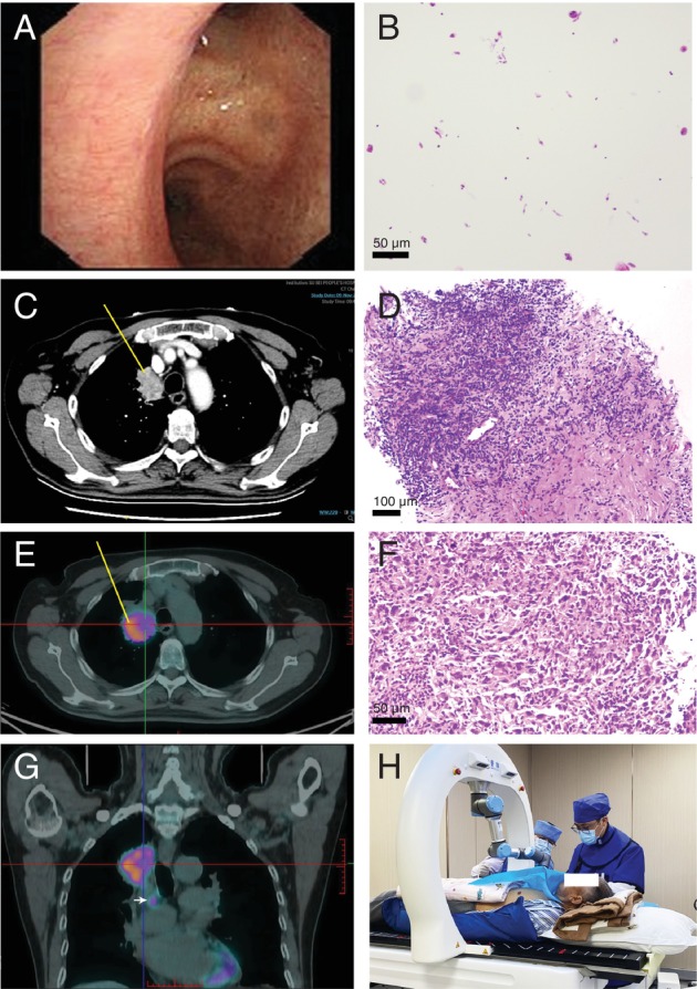 Enhancing the Precision and Efficiency of Pulmonary Tumor Detection With Robotic-Assisted <sup>18</sup>F-FDG PET/CT-Guided Lung Biopsy: A Case Report.