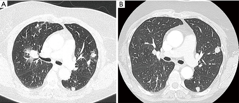 Efficacy and safety of dostarlimab in elderly patients with multiple comorbidities and allergic diathesis: case report.