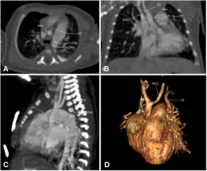 A comparative analysis of CT angiography and echocardiography in the evaluation of chest findings in patients with interrupted aortic arch.