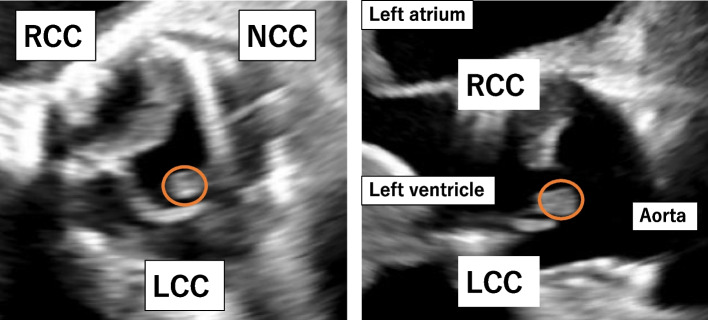 Infective endocarditis with perivalvular abscess following sutureless valve implantation, successfully treated with aortic root reconstruction and biological Bentall procedure.