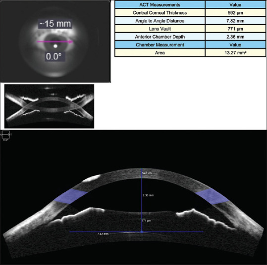 Objective and subjective outcomes following implantable collamer lens (ICL) implantation for the correction of myopia.