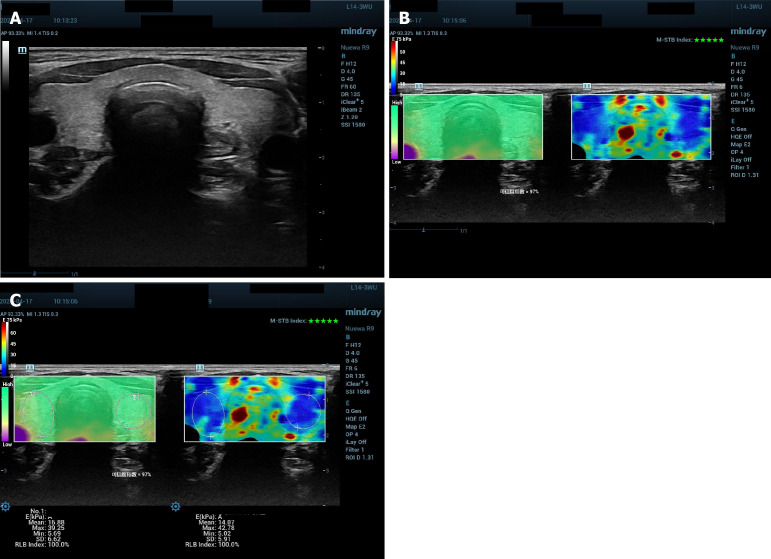Value of two-dimensional shear wave elastography quantitative analysis for evaluation of thyroid function in first trimester pregnancy.