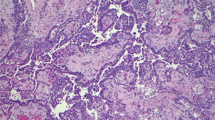 Aggressive Craniospinal Recurrence of a <i>PTEN</i>-Mutated Sinonasal Teratocarcinosarcoma: A Case Report.