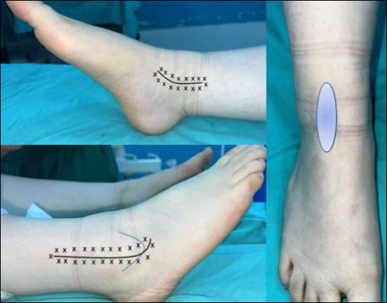 A randomized prospective clinical study comparing wide-awake local anesthesia no tourniquet (WALANT) and spinal anesthesia in the surgical treatment of ankle fractures.