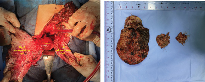 Silent Threat: Bilateral Giant Asymptomatic Endometriotic Cysts With Unilateral Sudden Rupture-A Case Report.