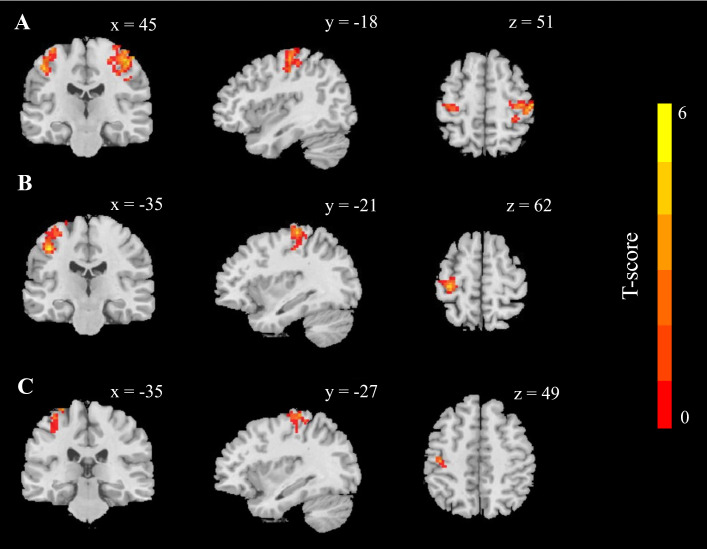 Effects of Intermittent Fasting on Anxiety and the Functional Connectivity of the Amygdala in Healthy Adults.