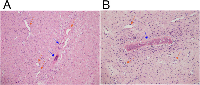 Novel <i>FRMD6::PTH</i> chimera in tumorous bone lesion carrying a t(4;11;14;12)(q35;p15;q22;q13).